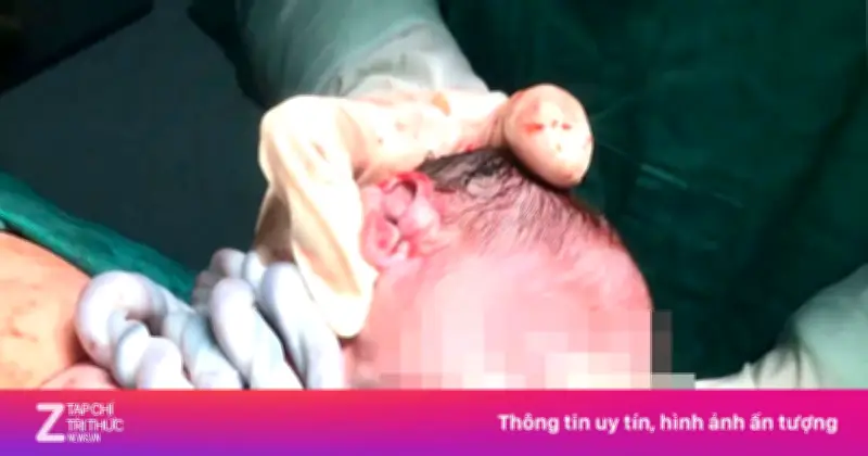 Thai Nhi Bị Dây Rốn Quấn Cổ 5 Vòng Hiếm Gặp Được Cứu Sống Kịp Thời