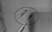 Xương cá dài 3cm đâm thủng ruột non, bác sĩ cảnh báo nguy hiểm từ mẹo dân gian
