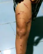 Bé gái lớp 5 bị chị họ dùng dao rạch nhiều vết trong 6 ngày tại nhà bà ngoại