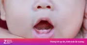 Dấu hiệu nhận biết trẻ bắt đầu mọc răng sữa và cách chăm sóc hiệu quả