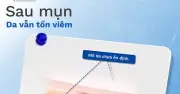 Giải mã cơ chế thâm sẹo sau mụn và gợi ý routine phục hồi da hiệu quả