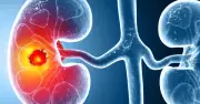 Ung thư thận gia tăng toàn cầu: 3 dấu hiệu cảnh báo dù ở giai đoạn sớm hay muộn