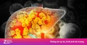 Thói quen xấu khó bỏ gây tổn thương gan nghiêm trọng, nhiều người vẫn làm hàng ngày