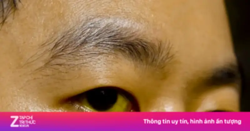 5 Dấu Hiệu 'Báo Động Đỏ' Cảnh Báo Gan Đang Bị Tàn Phá Nghiêm Trọng