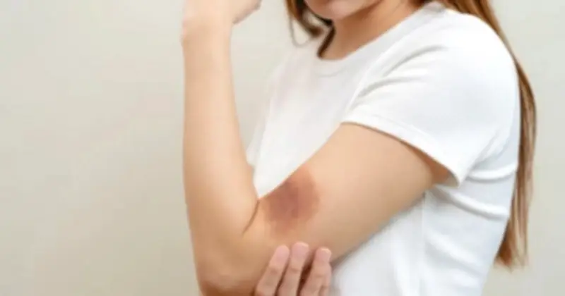 5 Dấu Hiệu Trên Da Cảnh Báo Gan Đang Gặp Vấn Đề, Không Nên Bỏ Qua