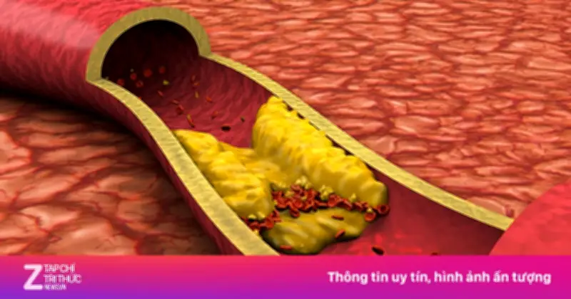 5 Điểm Mới Trong Sàng Lọc Và Điều Trị Mỡ Máu Theo Tiêu Chuẩn Mỹ