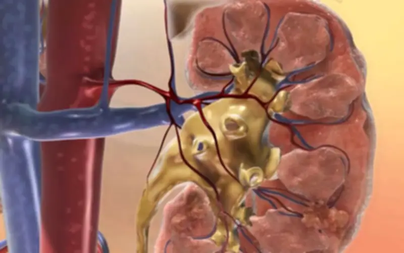 7 Việc Quan Trọng Người Việt Cần Làm Ngay Để Bảo Vệ Thận, Ngăn Ngừa Suy Thận