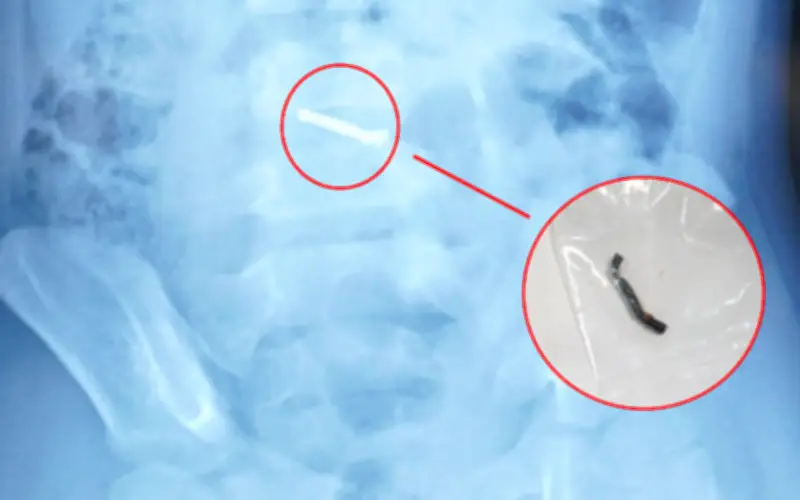 Bé trai 5 tuổi thủng ruột vì nuốt nam châm từ đồ chơi, bác sĩ cảnh báo nguy hiểm
