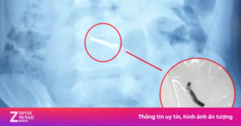 Bé trai 5 tuổi thủng ruột vì nuốt nhiều viên nam châm từ đồ chơi