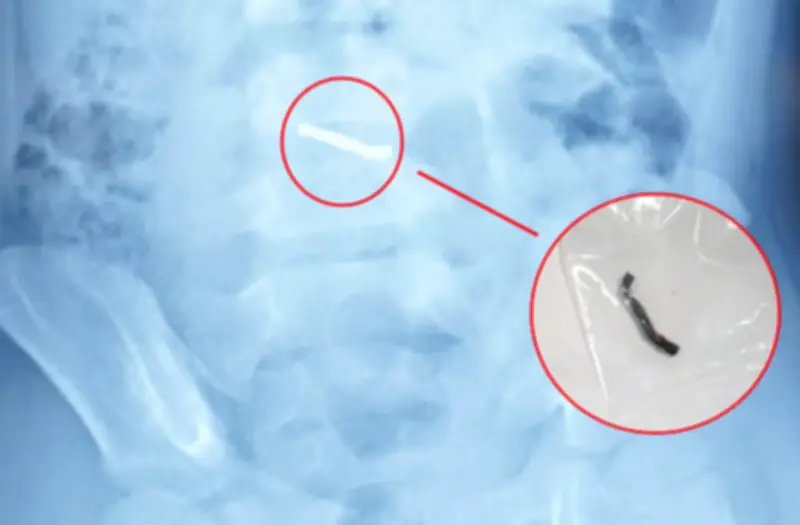 Bé trai nuốt nhiều viên nam châm nhỏ trong đồ chơi, gây thủng ruột