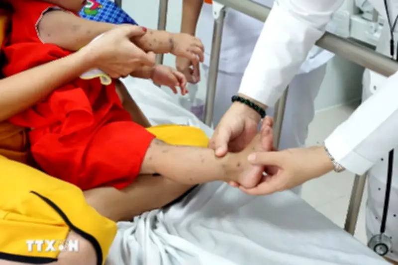 Bộ Y tế yêu cầu tăng cường thu dung, điều trị khi ca bệnh tay chân miệng tăng mạnh