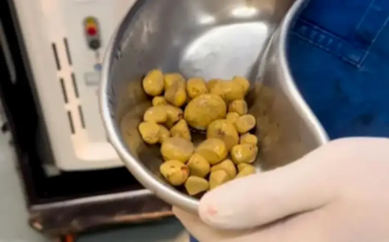 Bác sĩ Brazil lấy hàng chục viên sỏi từ bàng quang bệnh nhân nghiện nước ngọt