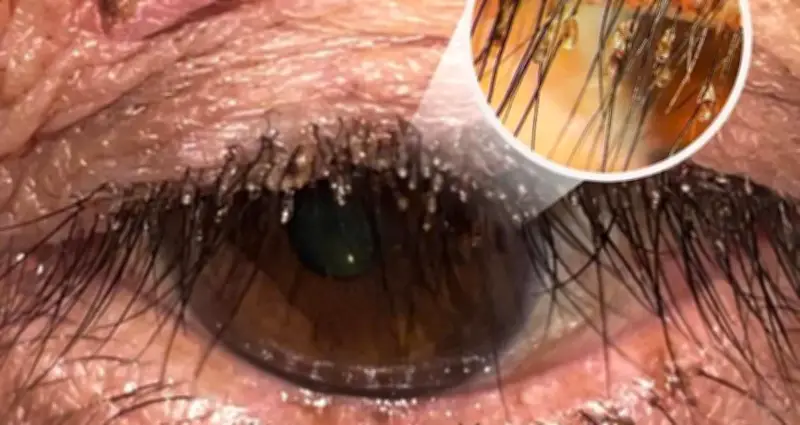 Bác sĩ bất ngờ phát hiện ổ rận mu bám chi chít trên lông mi người phụ nữ