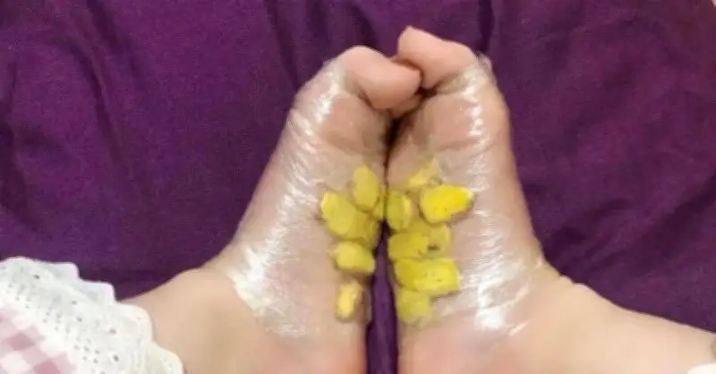 Bác sĩ giải đáp: Đắp gừng sao khô lên lòng bàn chân có hiệu quả chữa cảm lạnh cho trẻ?