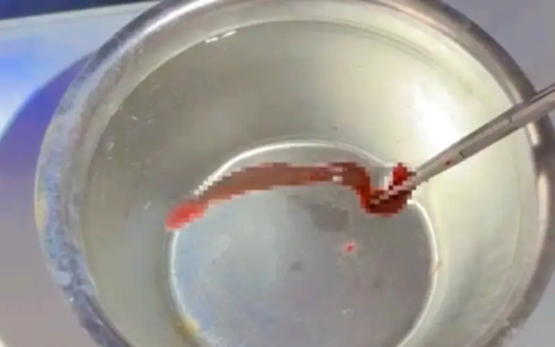 Bác sĩ Quảng Trị gắp thành công con đỉa sống 5cm trong mũi bệnh nhân