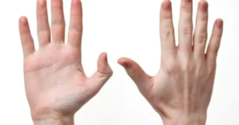 Bàn Tay Cảnh Báo Sức Khỏe: 3 Dấu Hiệu Bất Thường Dễ Bỏ Qua Có Thể Liên Quan Đến Ung Thư