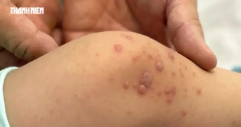 Bùng Phát Tay Chân Miệng: 4 Ca Tử Vong, Vắc Xin Mới Được Cấp Phép Nhưng Chưa Có Giá