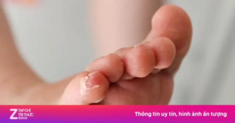 Bệnh Giang Mai Bùng Phát Mạnh Tại Trung Quốc: Nguyên Nhân Và Thách Thức