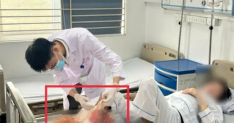 Bệnh nhân bỏng tự đắp lá, suýt mất chân vì hoại tử nặng