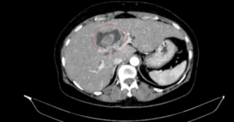 Bệnh nhân hiếm gặp: Đồng thời mắc hai ung thư nguyên phát trong hệ tiêu hóa