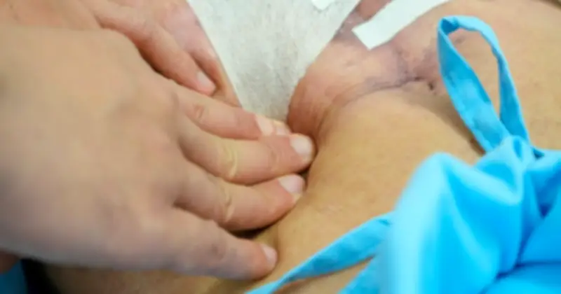 Bệnh nhân thủng dạ dày ngưng tim trên bàn mổ được cứu sống sau 3 tháng điều trị