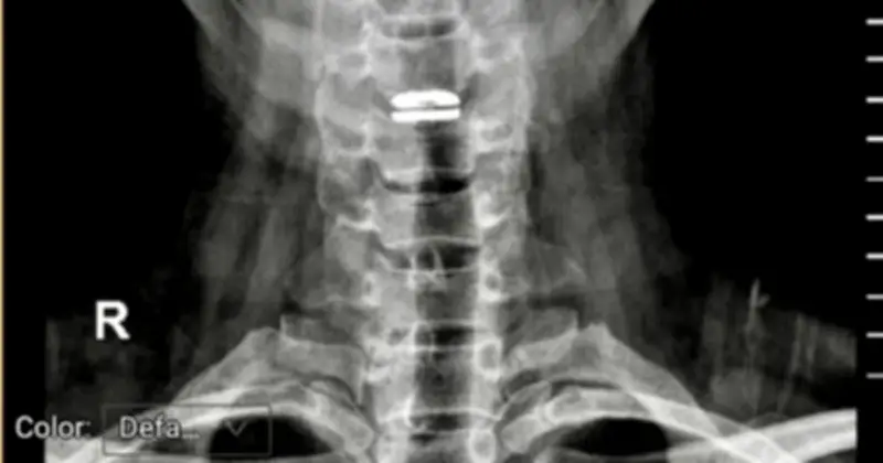 Bệnh nhân thoát vị đĩa đệm cổ được thay đĩa đệm nhân tạo, thoát nguy cơ liệt