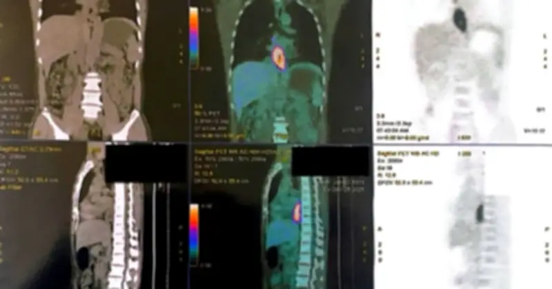Bệnh nhân ung thư đa ổ do thói quen uống rượu lâu năm tại Bệnh viện Bạch Mai