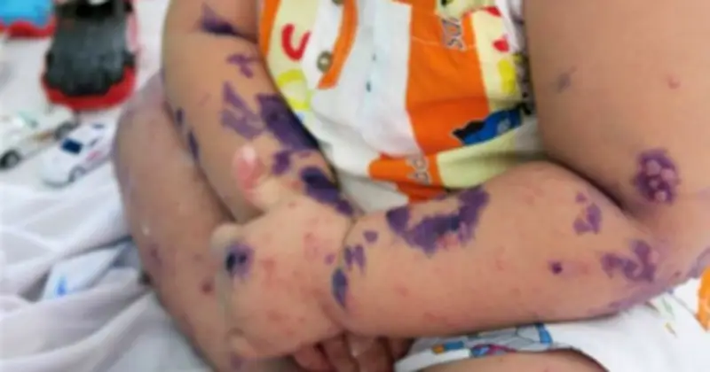 Bệnh tay chân miệng bùng phát: Gần 3.000 trẻ mắc, số ca nội trú tăng gấp đôi