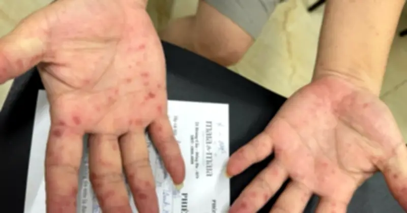 Bệnh tay chân miệng gia tăng mạnh tại TP.HCM và cảnh báo từ chuyên gia