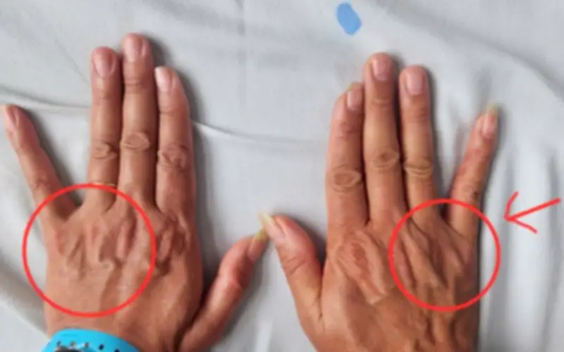 Bệnh viện 19-8 phẫu thuật thành công hội chứng chèn ép thần kinh trụ, cảnh báo dấu hiệu sớm