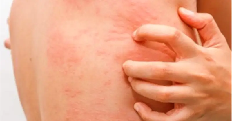 Bệnh viện Bạch Mai điều trị thành công ca hiếm mắc đồng thời hai ung thư nguyên phát