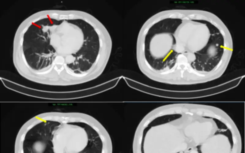 Bệnh viện Bạch Mai điều trị thành công ca hiếm mắc đồng thời ung thư phổi và tuyến tiền liệt
