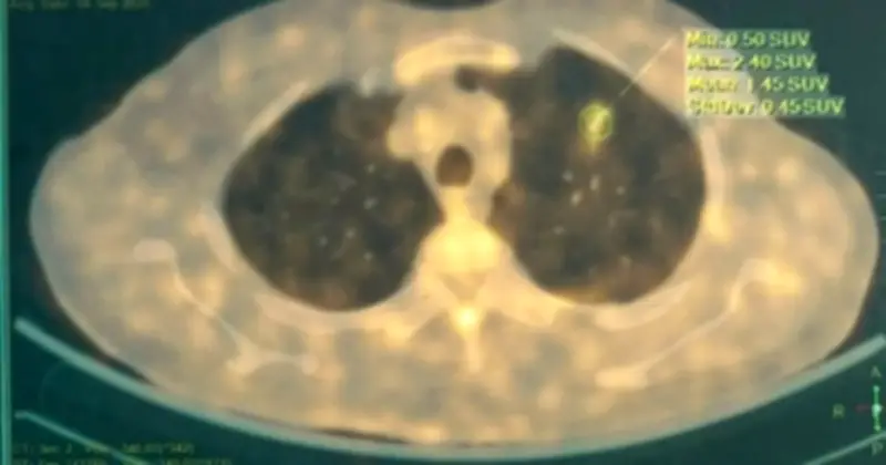 Bệnh viện Bạch Mai ra mắt AI 'Make in Bạch Mai' hỗ trợ chẩn đoán sớm ung thư phổi