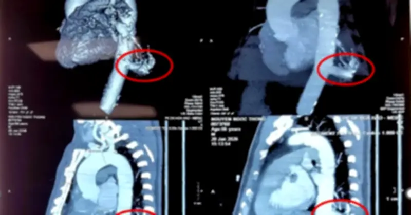 Bệnh viện Bình Dân thực hiện thành công ca phẫu thuật robot đầu tiên điều trị phổi biệt lập