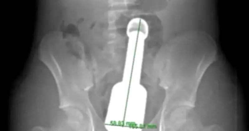 Bệnh viện Hà Đông cứu thiếu niên 15 tuổi khỏi dị vật kim loại 18cm trong trực tràng