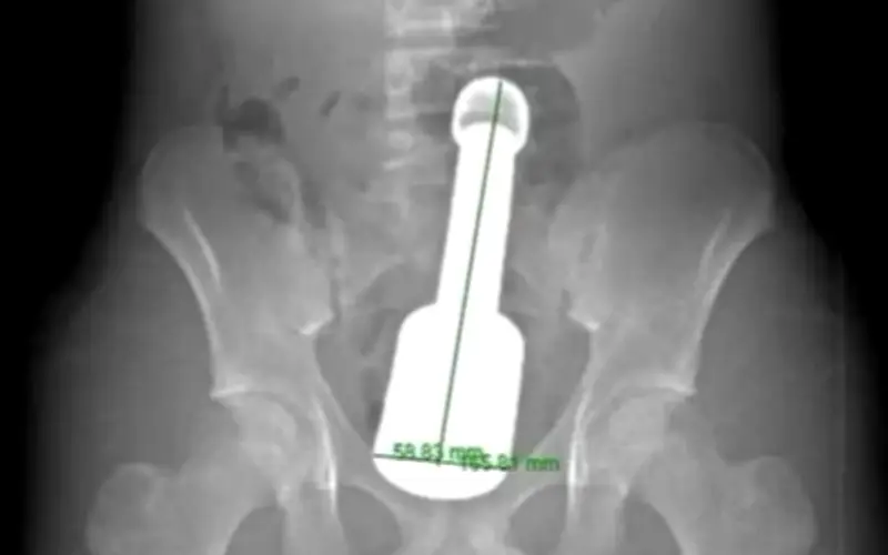 Bệnh viện Hà Đông lấy thành công dị vật kim loại 18cm khỏi trực tràng bệnh nhân 15 tuổi