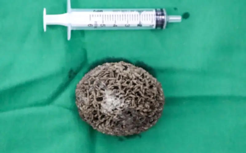 Bệnh viện Ngoại khoa 115 Nghệ An phẫu thuật thành công lấy sỏi bàng quang kích thước lớn