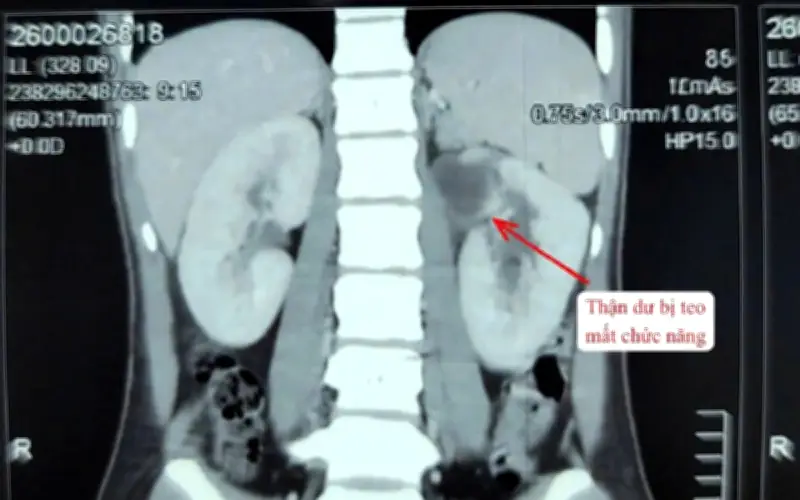 Bệnh viện Quảng Nam phẫu thuật thành công ca dị tật 3 thận hiếm gặp