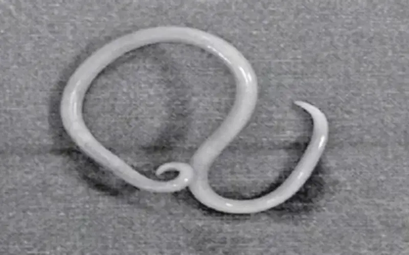 Bệnh viện Quảng Nam phẫu thuật thành công cho thiếu niên 15 tuổi bị thủng ruột do giun đũa