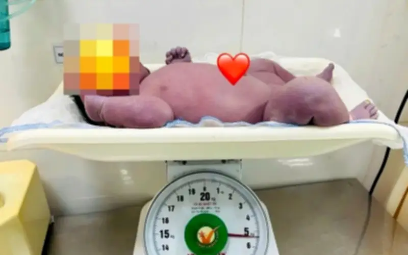 Bệnh viện Tân Yên phẫu thuật thành công sản phụ sinh con 5,4 kg có sẹo mổ cũ