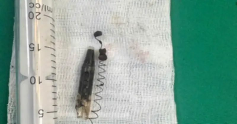 Bút Bi Găm Trong Thái Dương 13 Năm, Bệnh Nhân Đau Đớn Kéo Dài