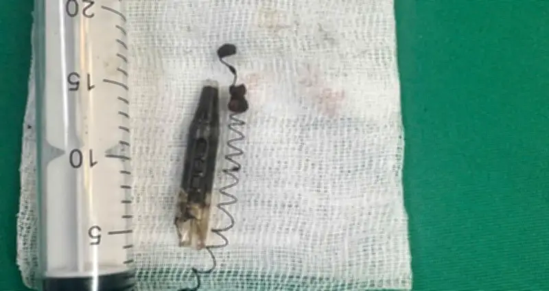 Bút Bi Găm Trong Thái Dương 13 Năm Được Phẫu Thuật Thành Công Tại Quảng Ninh