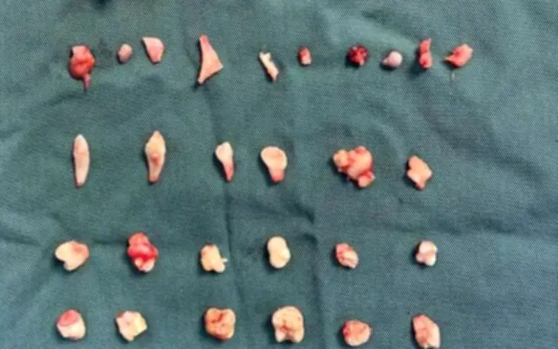 Cô gái 18 tuổi phát hiện khối u chứa 24 chiếc răng trong bụng khi tập thể dục