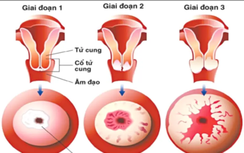 Cô gái 20 tuổi ở Hà Nội khám tiền hôn nhân, bất ngờ phát hiện tiền ung thư cổ tử cung