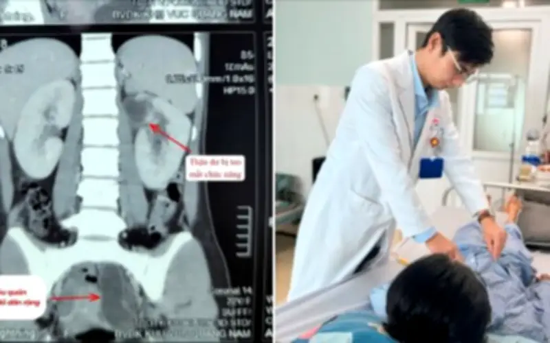 Cô gái 22 tuổi mất chức năng thận vì đi tất hiểm, bác sĩ cảnh báo dấu hiệu dễ bỏ qua