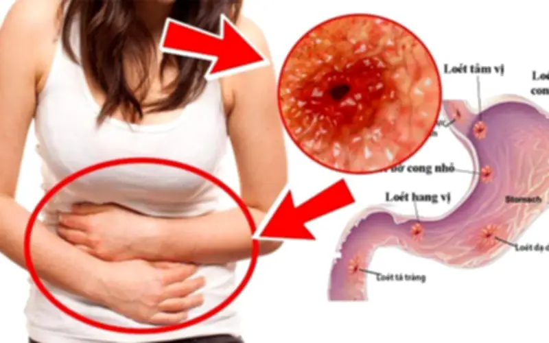 Cô gái 23 tuổi phát hiện ung thư dạ dày từ dấu hiệu nhiều người Việt bỏ qua