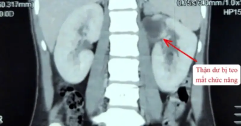 Cô gái hiếm gặp sở hữu ba quả thận: Câu chuyện y học đặc biệt