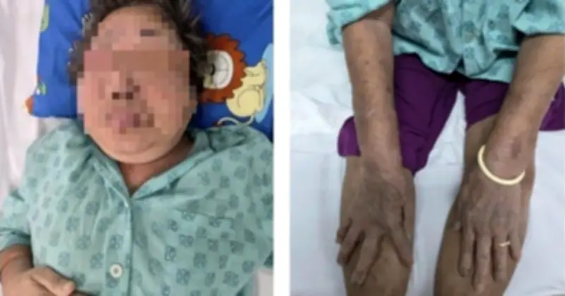 Cụ ông 87 tuổi suy kiệt vì tự ý dùng thuốc giảm đau không rõ nguồn gốc