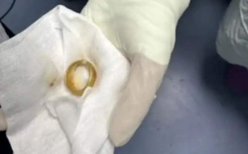 Cụ ông 95 tuổi nuốt nhẫn vàng được cứu sống nhờ phát hiện kịp thời