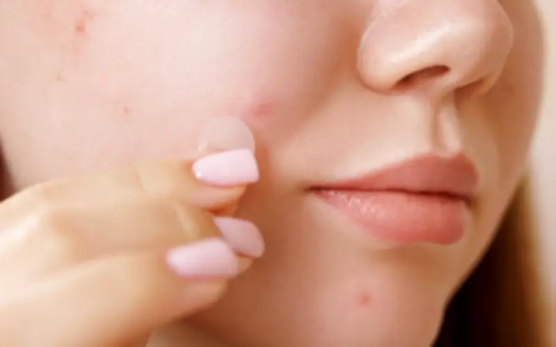 Có nên dùng miếng dán mụn sau khi nặn mụn không? Chuyên gia giải đáp